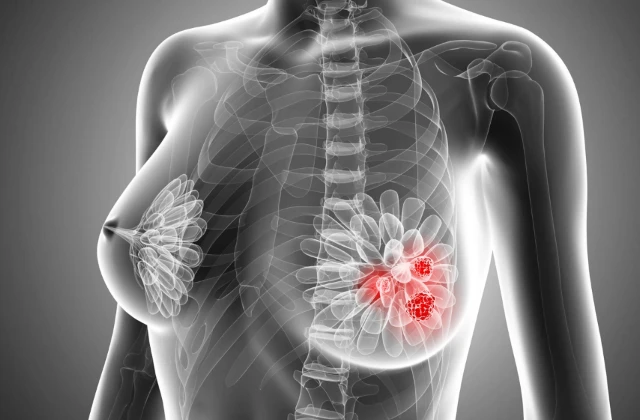Cáncer de mama, mastografías y seguro de gastos médicos en México